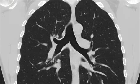 the villages lung ct scan|Chest CT Scan .